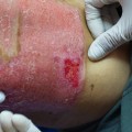 Skin Grafts: A Comprehensive Overview