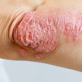 Psoriasis: A Comprehensive Overview of Causes, Symptoms, and Treatments