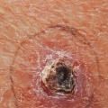 Skin Cancer Treatments: A Comprehensive Overview