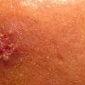 Everything You Need to Know About Shingles