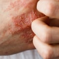 Eczema: A Comprehensive Overview