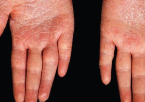 Psoriasis Treatments: A Comprehensive Overview