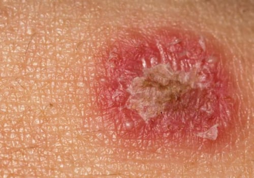 Ringworm: Everything You Need to Know