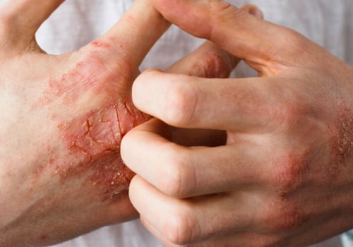 Eczema Treatments: A Comprehensive Overview